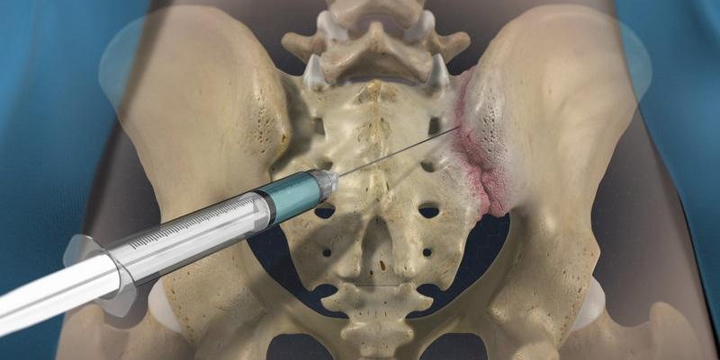 Sacroiliac Pain Relief Injection SI Joint Pain Management