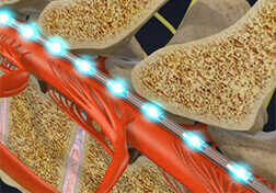 Spinal Cord Stimulator Implant